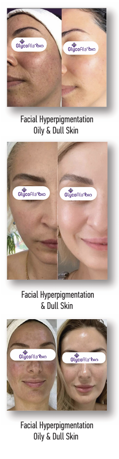 glycoala non invasive rejuvenation rochester